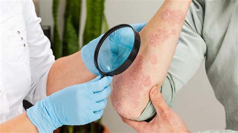 scratch test for psoriasis|psoriasis diagnosis results.